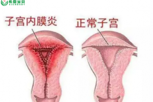 希恩宝贝-子宫内膜炎患者试管婴儿成功率：哈萨克斯坦医疗数据揭示突破性进展