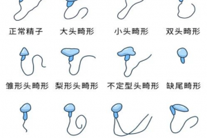 希恩宝贝-精子畸形率高（畸精症）试管选性别：第三代技术能否筛选？